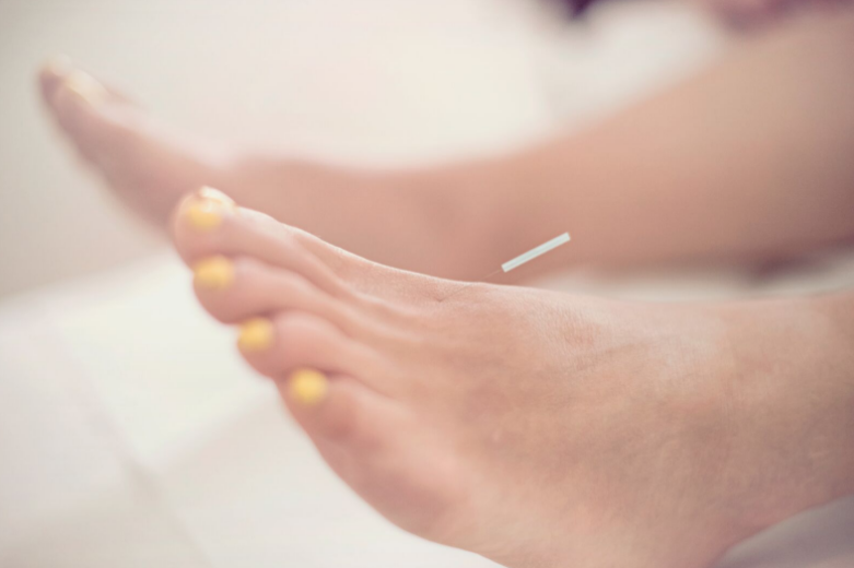 Acupuncture needle placed in foot at London clinic