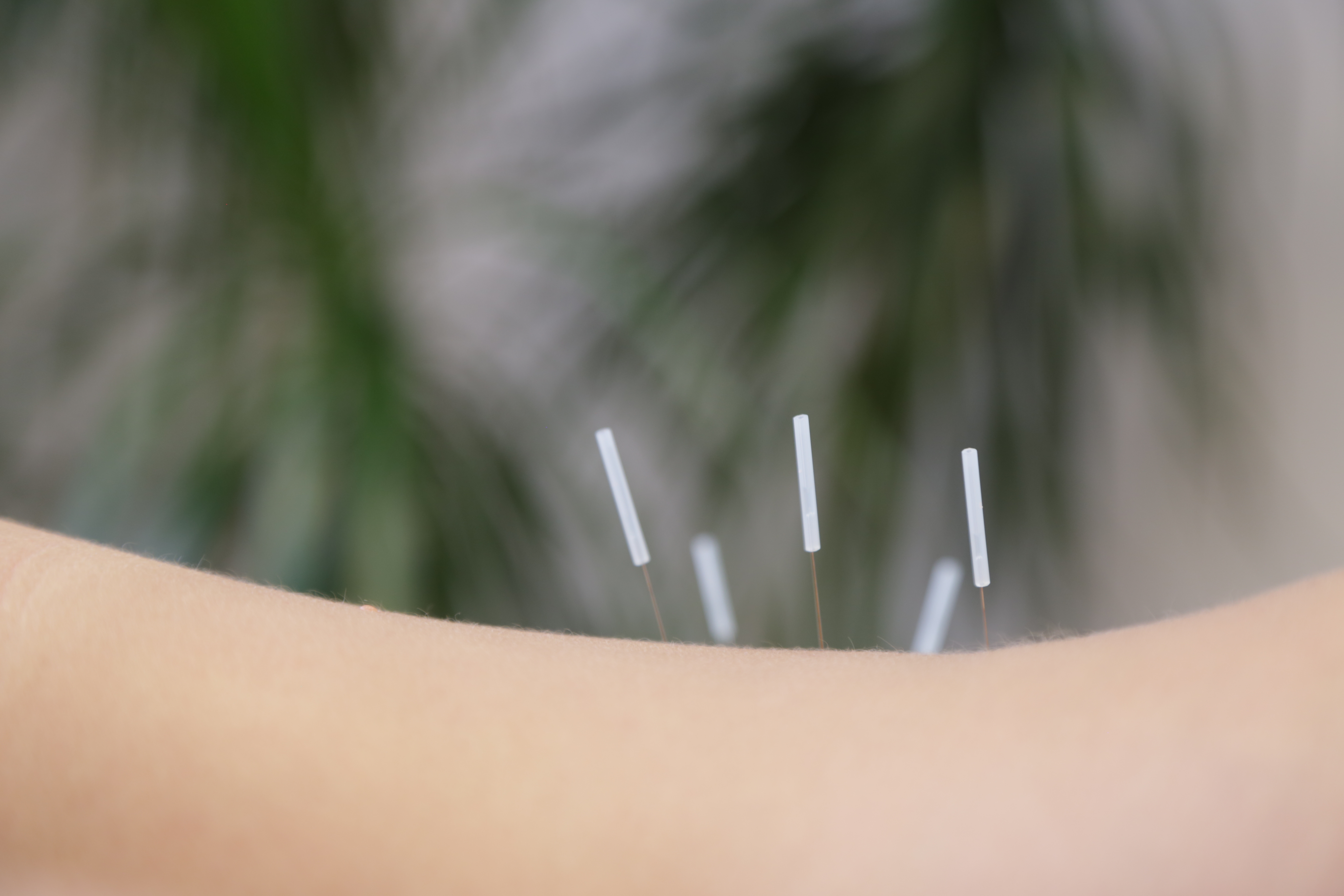 Improving male fertility with acupuncture at London clinic